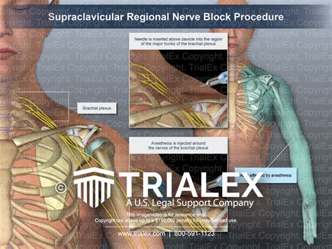 Cpt nerve block. Things To Know About Cpt nerve block. 